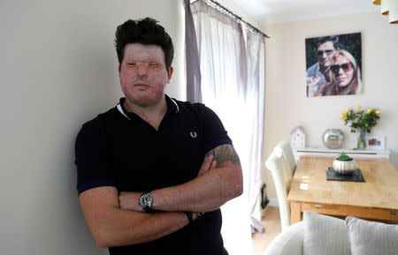 Acid attack victim Andreas Christopheros, poses for a photograph in his home in Truro, south-west England, Britain July 31, 2017. REUTERS/Peter Nicholls