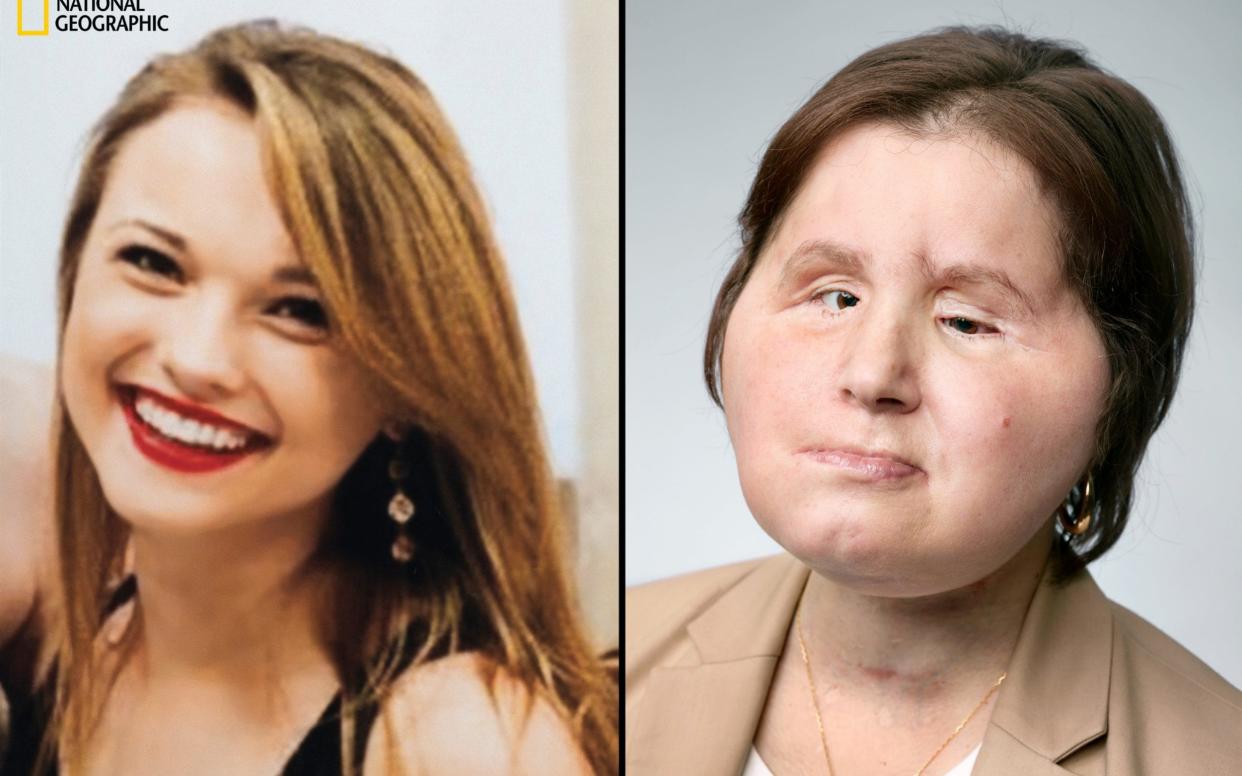 Katie Stubblefield shot herself in the face in 2014. she had a face transplant in 2017