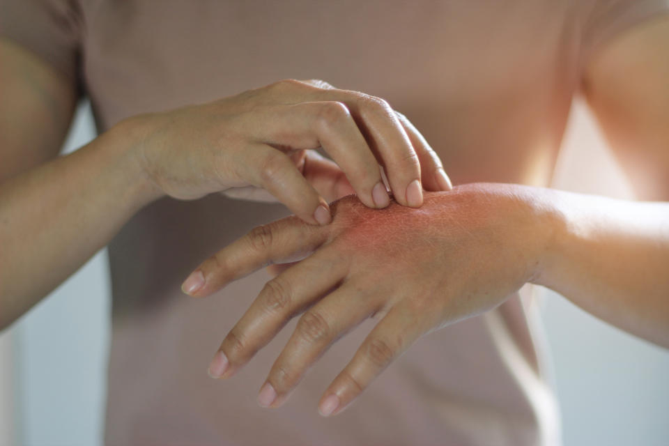 濕疹發作時，皮膚常會發癢紅腫，常見的異位性皮膚炎便屬於濕疹的一種。（示意圖／Getty Images）