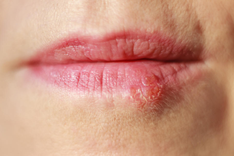 Causes of cold sores and how to treat cold sores and skin conditions (ancoay / Getty Images stock)