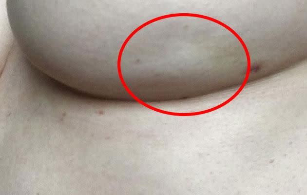 Claire posted a pic of her left breast to increase awareness about the signs of breast cancer. Photo: Facebook