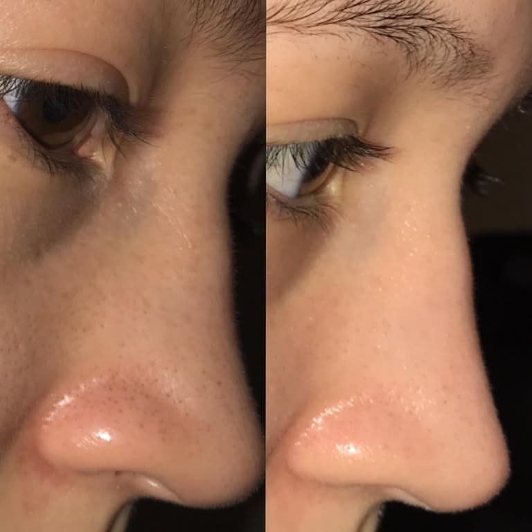 This woman found a way to remove her blackheads once and for all