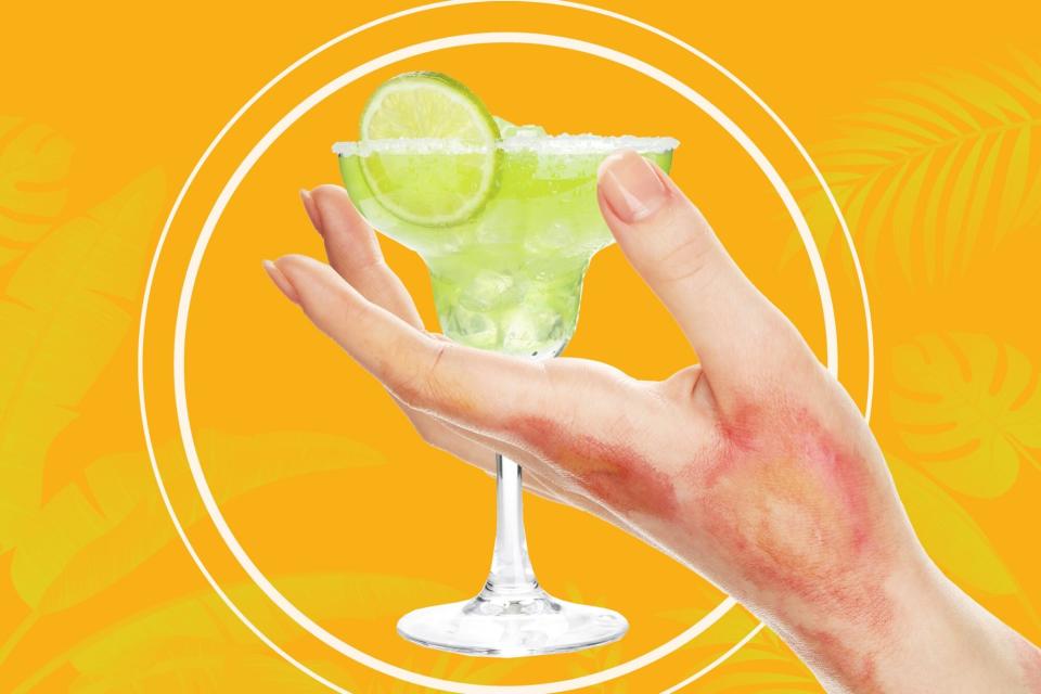 What-Is-Margarita-Burn-AdobeStock_76419661-111621029