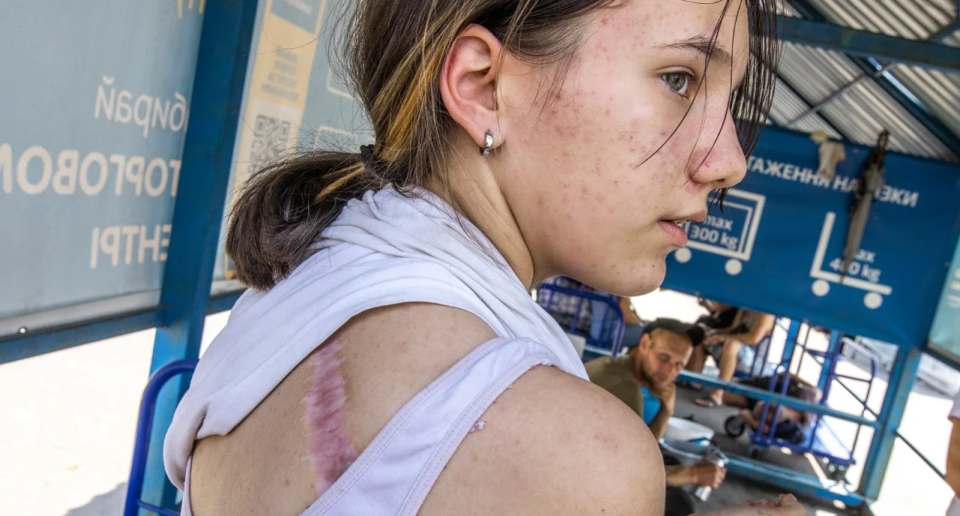 14-year-old Sofia shows a scar from an injury she received in Mariupol in April <span class="copyright">Oleksandr Medvedev / NV</span>