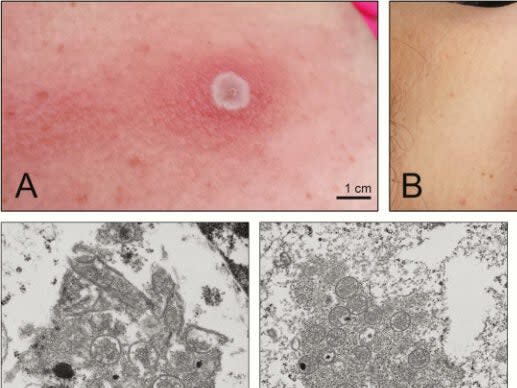 Images of the virus known as “Alaskapox” (Alaska Public Media)