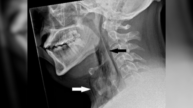 Causes of a “Crackling” Sound in the Neck - Inspired Spine