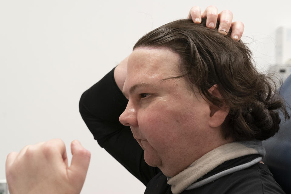 Joe DiMeo demonstrates how he can arrange his hair, Monday, Jan. 25, 2021 at NYU Langone Health in New York, six months after an extremely rare double hand and face transplant. In the 23-hour procedure the medical team replaced his full face, including the forehead, eyebrows, nose, eyelids, lips, both ears and underlying facial bones. (AP Photo/Mark Lennihan)