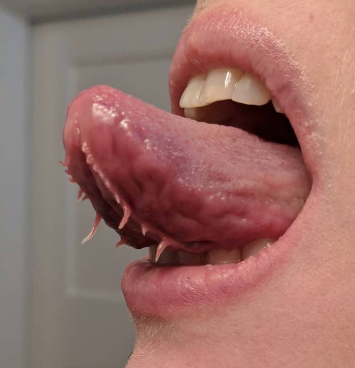 Close-up of a person's mouth with their tongue sticking out, showing "tentacle-like" protuberances on the bottom