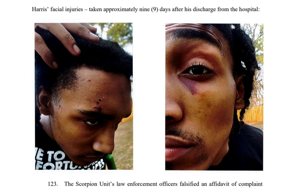 This photo shows Harris’ facial injuries about nine days after he was released from the hospital after the beating, according to the lawsuit.