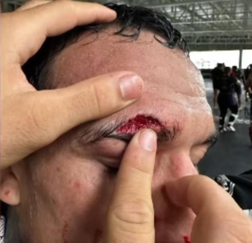 Oliveira shows the cut that derailed his planned rematch with Makhachev (DamonMartin / X)
