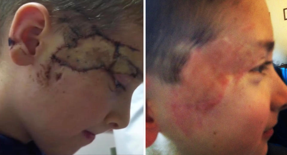 Hunter Kilbourn with scars on the side of his face after dog attack; Hunter healing from skin grafts