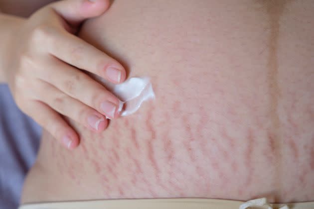 Some estimates suggest 90% of expectant moms get stretch marks.  (Photo: Sutthiwat Srikhrueadam via Getty Images)