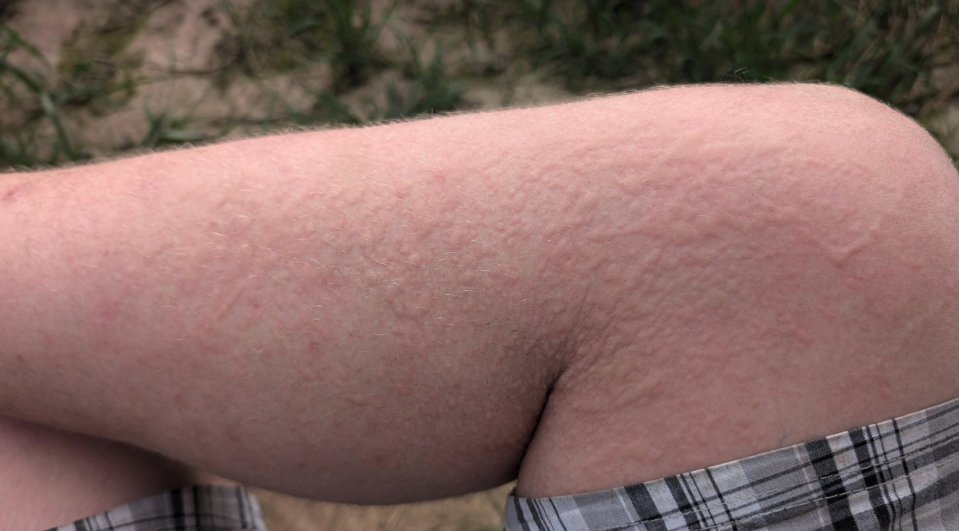 Close-up of a person's arm showing textured skin. Part of a pair of checkered shorts is visible