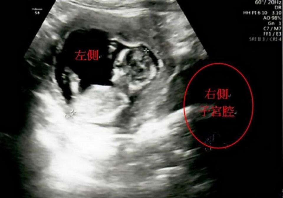 陳婦經接受陰道中隔切除術後，成功受孕後第12週時的超音波檢查。（記者陳金龍翻攝）