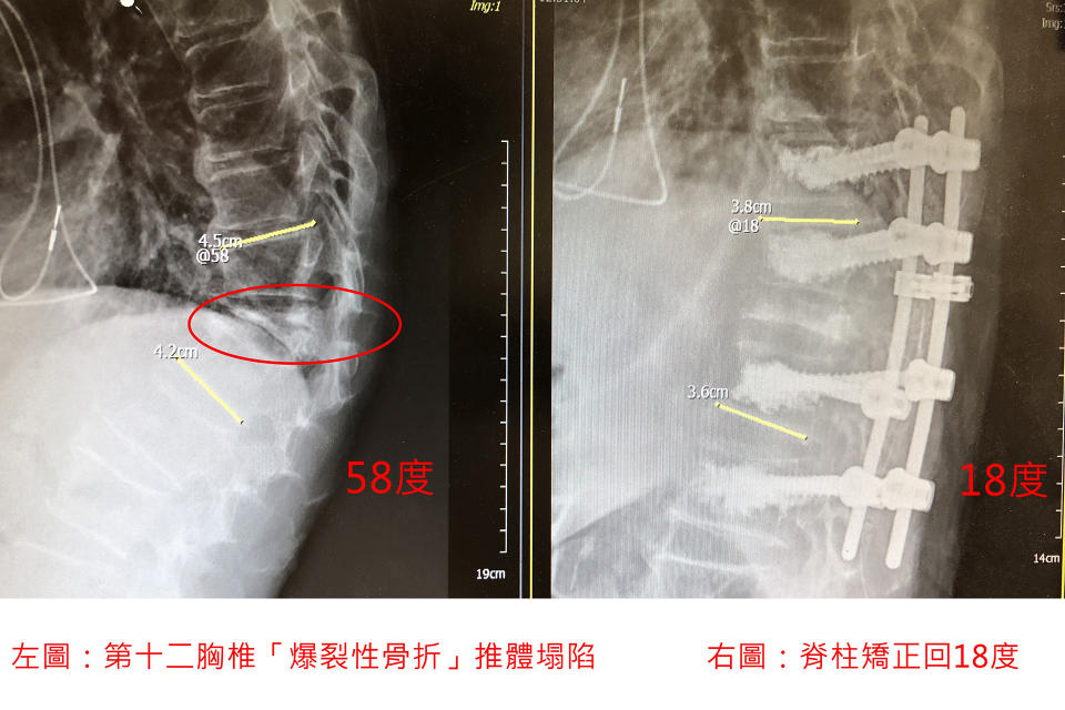 病人駝背58度的脊柱矯正回18度X光片對照。