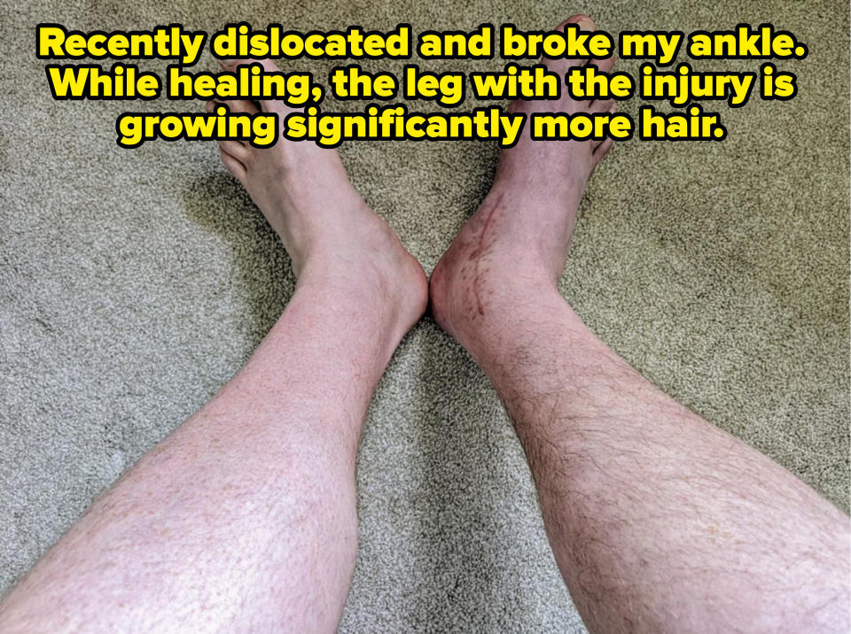 person's legs, one injured and with more hair