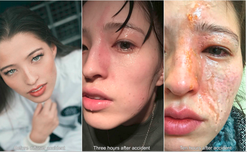 A woman suffered horrific burns from diffusing essential oils. Photo: Facebook/Emily Smith