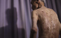 FILE - In this June 30, 2015, file photo, Sumiteru Taniguchi, a survivor of the 1945 atomic bombing of Nagasaki, shows his back with scars of burns from the atomic bomb explosion, during an interview at his office in Nagasaki, southern Japan. With dwindling survivors, Nagasaki marked 75th anniversary of US atomic bombing that killed more than 70,000 people on Sunday, Aug. 9, 2020. (AP Photo/Eugene Hoshiko, File)