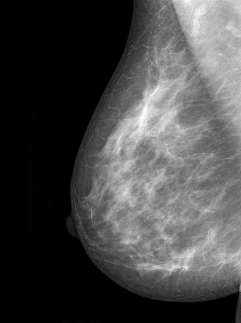 Dense breast tissue