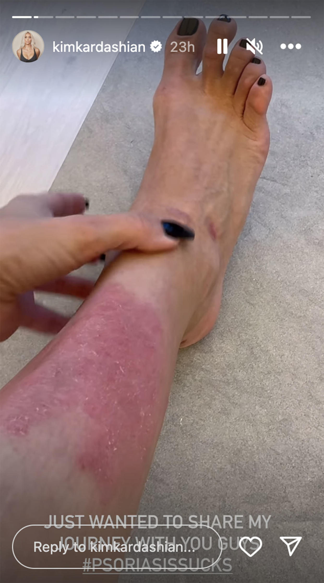 Kim Kardashian shares up close pics of her psoriasis and her hack for easing her symptoms (@kimkardashian via Instagram)