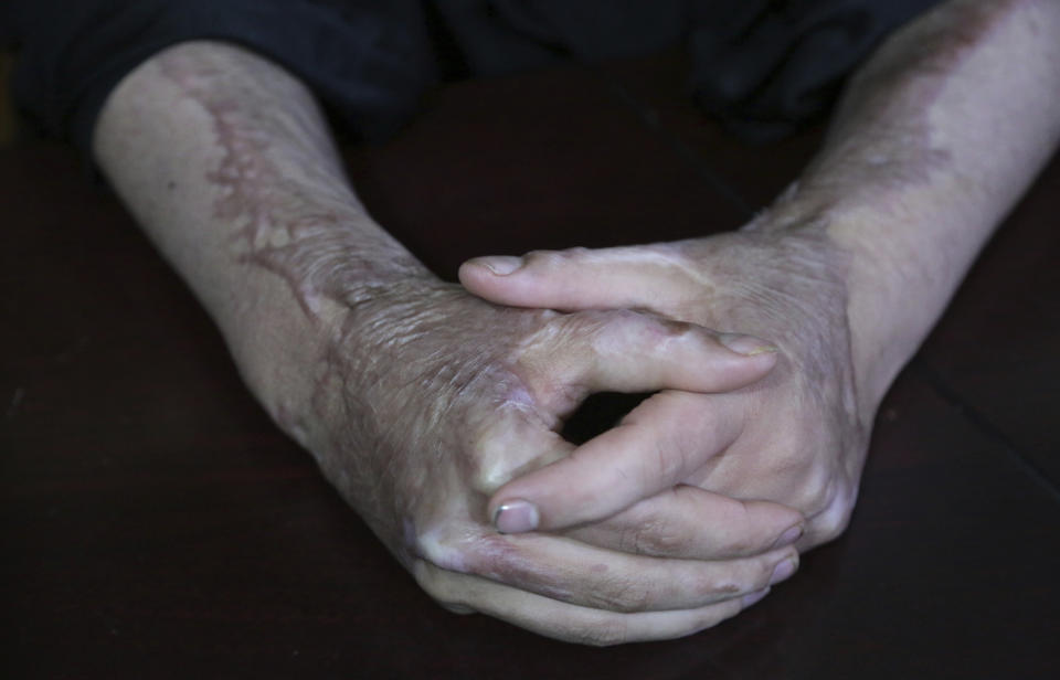 In this Monday, Feb. 18, 2019, photo, Khadeja, 18, who was burned by a pot of scalding hot water thrown by her husband, speaks during an interview with the Associated Press at a women's shelter office in Herat, Afghanistan. The suffering of young women like Khadeja is why women rights activists say they are demanding a seat at the table in negotiations between the government and the Taliban over peace and Afghanistan’s future. (AP Photo/Rahmat Gul)