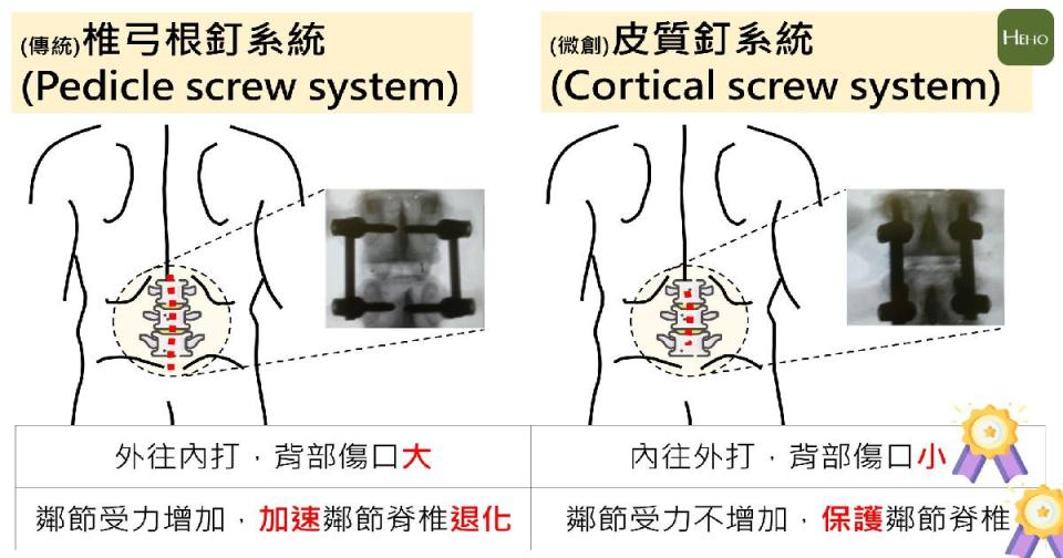 傳統椎弓根釘系統和微創皮質釘系統的比較(圖中X光影像出自參考資料)。(製圖者/義大醫院 林怡汎 醫師)