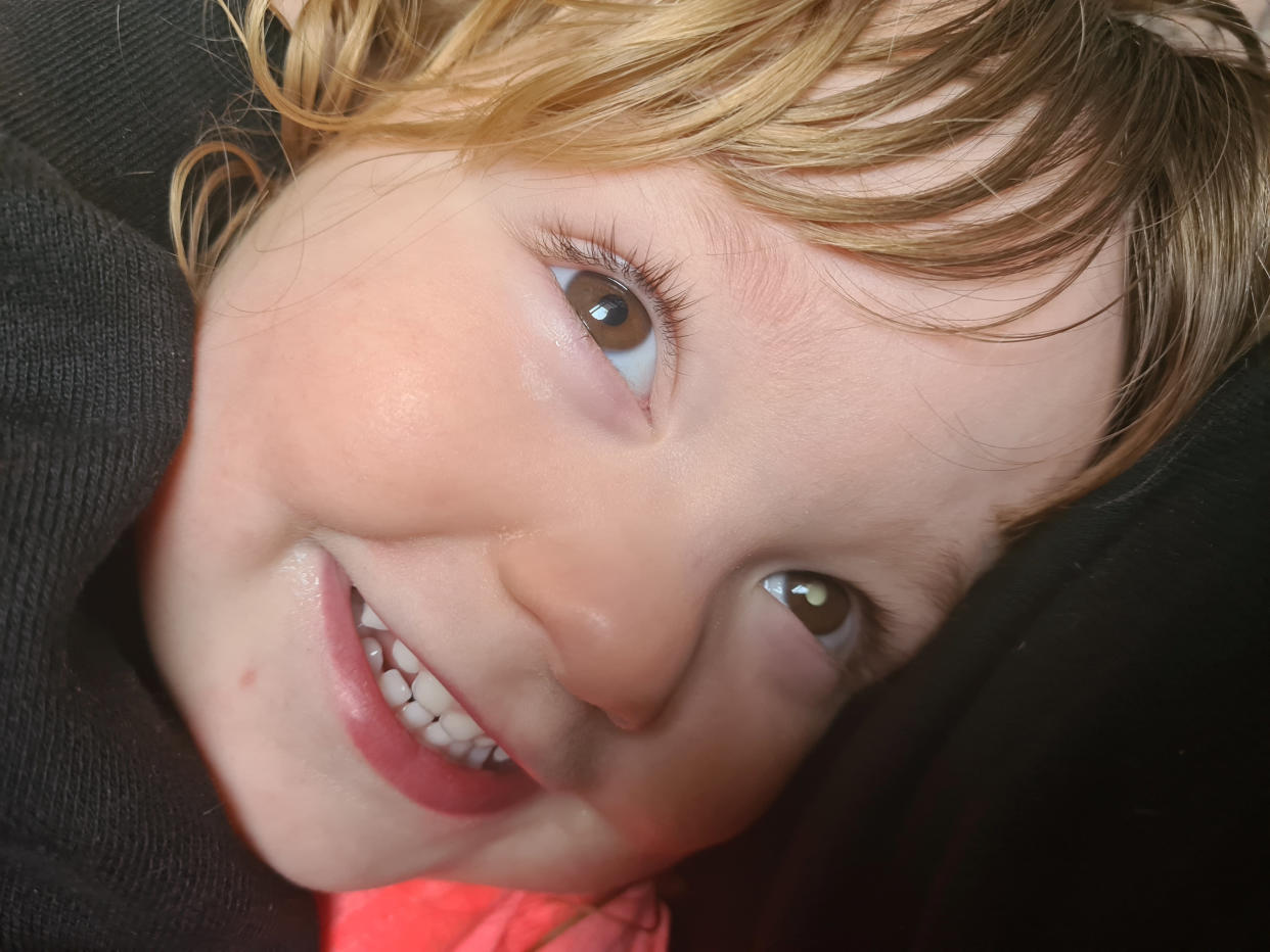 Darcey-Rose Hickson with white glow in her eye, which was as sign of a rare cancer. (Childhood Eye Cancer Trust/SWNS)