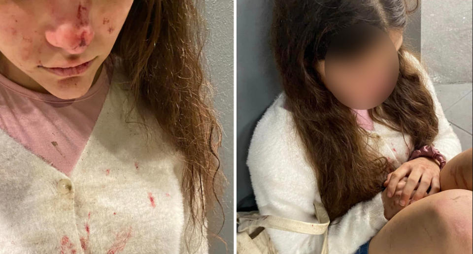 The 14-year-old who was attacked can be seen with scratches across her face and blood over her top.