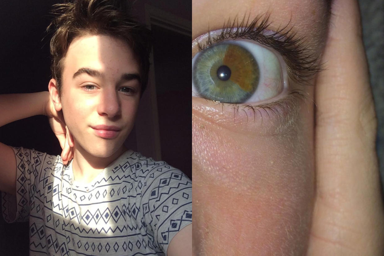 Jay Davis has a genetic eye condition, but he embraces it and calls it beautiful. (Photo: Instagram/jaydv1s)