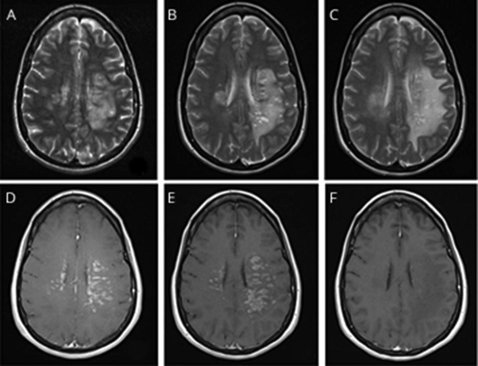 MRI images show scans of Rebecca Wrixon's brain on the day she was admitted to hospital (A), six days after admission (B) and 17 days after admission (C), with inflammation appearing in a lighter shade. / Credit: American Academy of Neurology/University Hospital Southampton