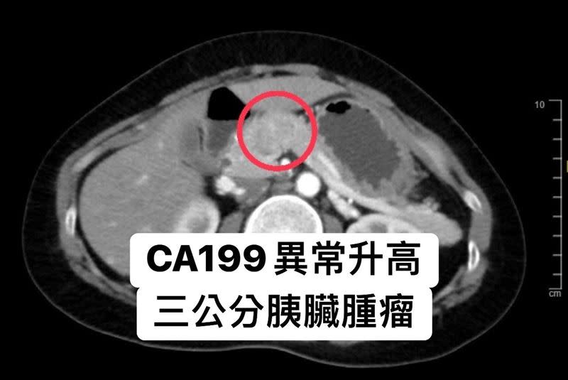 40歲女子有一顆3公分的胰臟腫瘤。（圖／翻攝自胰臟醫師 林相宏 禾馨民權內科診所 臉書）