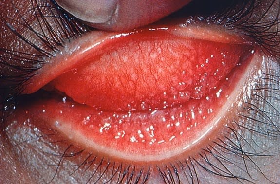 Eyelid inflammation caused by the <i>Chlamydia trachomatis</i> bacterium, known as trachoma. The disease is the leading cause of preventable blindness in the world today and has infected humans for millenia.