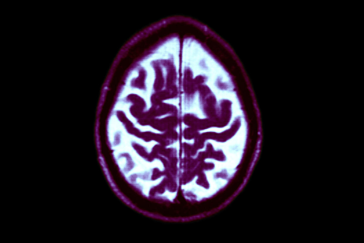 Alzheimer Disease, Mri (BSIP / Universal Images Group via Getty file)