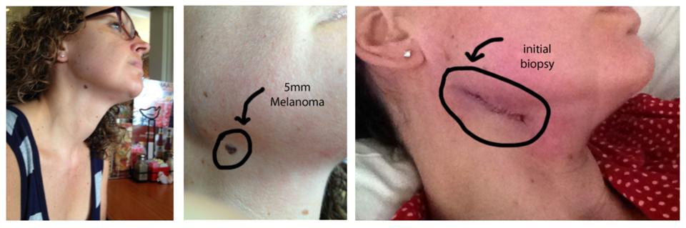 Le cas de mélanome suivant de Tracy Callahan a été repéré sur sa cheville et a nécessité plusieurs points de suture. (Photo: Tracy Callahan)