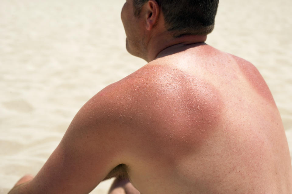 Man with sun burnt shoulders sitting on beach. (Ian Hooton / Getty Images)