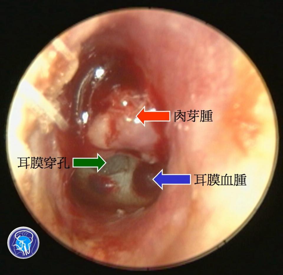 病患耳道內破皮帶鮮血還有肉芽腫，碰觸會痛；且耳膜破了，上面還出現數顆血腫。（圖／醫師陳建志提供）