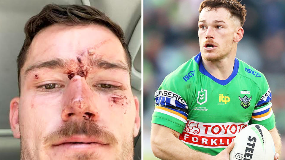 Tom Starling is pictured with cuts to his face after the December 2020 brawl on the left, and playing for the Canberra Raiders on the right.