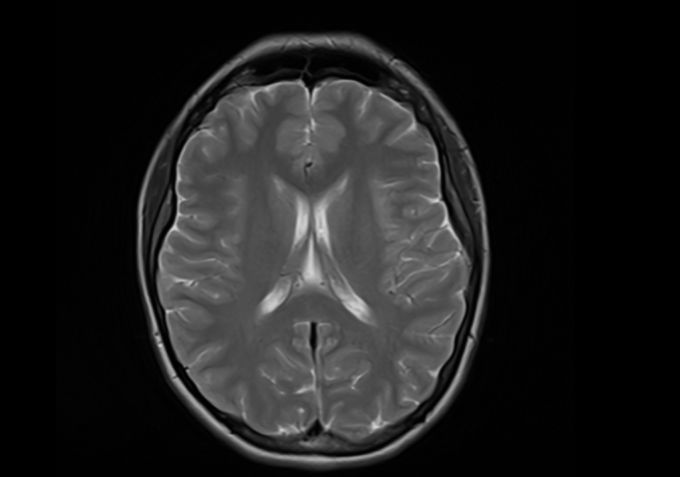 The scan takes an an image of each part of the body, including the brain. This is the image of my brain from the scan. (Photo via Aleah Balas, Whole Body MRI) 