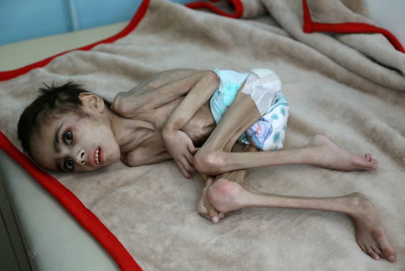 FILE PHOTO: Faid Samim, 7, a malnourished boy who also has cerebral palsy, lies on a bed at the malnutrition treatment ward of al-Sabeen hospital in Sanaa