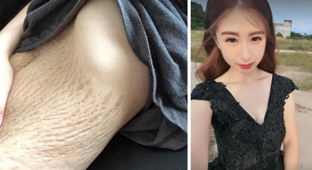 A mum’s image of her post-baby stretch marks is going viral [Photo: Facebook/Doreen Ching]