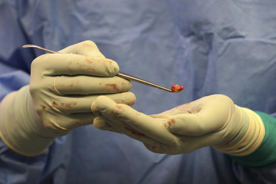 In this Jan. 14, 2020 photo, neurosurgeon Dr. Andrew Ko holds a small piece of healthy brain tissue removed from Genette Hofmann during brain surgery at Harborview Medical Center in Seattle in hopes of reducing the epileptic seizures that had disrupted Hofmann's life for decades. Hofmann agreed to donate a small bit of her healthy brain tissue to researchers, who were eager to study brain cells while they were still alive, joining a long line of epilepsy patients who've helped scientists reveal basic secrets of the brain. (AP Photo/Ted S. Warren)