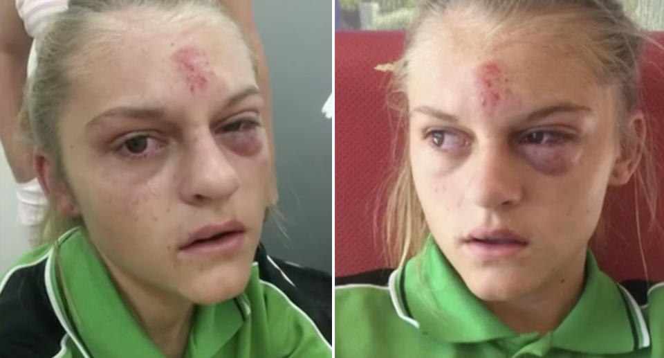 Vanessa Ninyette was left with a black eye and a badly bruised face after an incident at Swan View Senior High School on Friday. Source: 7 News