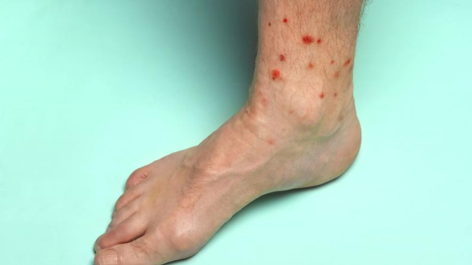 foot with summer insect bites