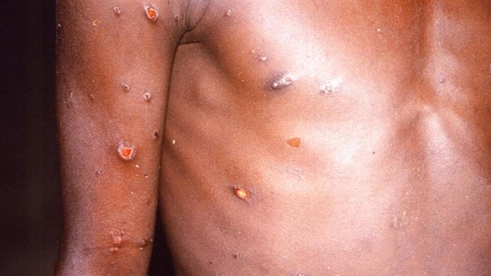 近期全球爆發猴痘疫情。（圖／AP）