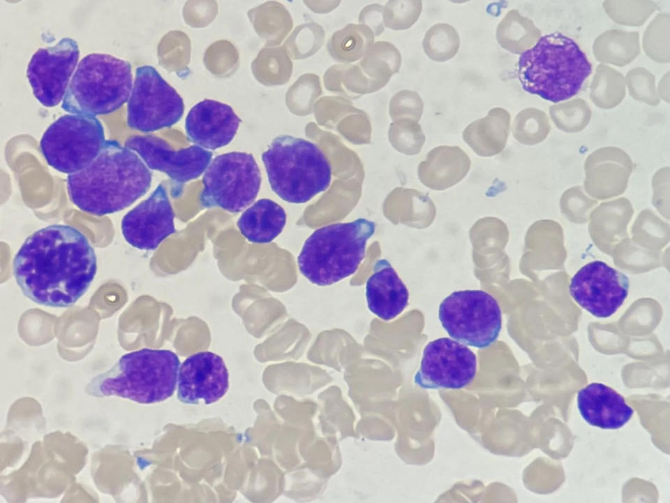 <strong>骨髓血在顯微鏡下只可見惡性白血病細胞，缺乏正常的各種造血細胞，這些癌細胞大部分只有細胞核，幾乎沒有細胞質。（圖／長庚醫院提供）</strong>