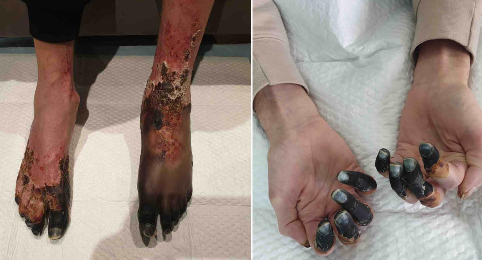 Male's black feet and finger tips after sepsis infection. 