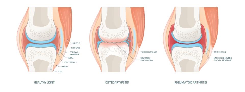 An illustration of joint cartilage