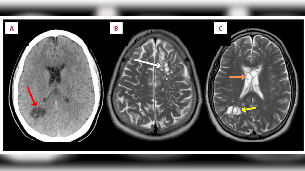  Three brain scan images depicted side by side and labelled a to c. Lesions containing the parasite Taenia solium are highlighted by arrows in white, red, orange and yellow. 