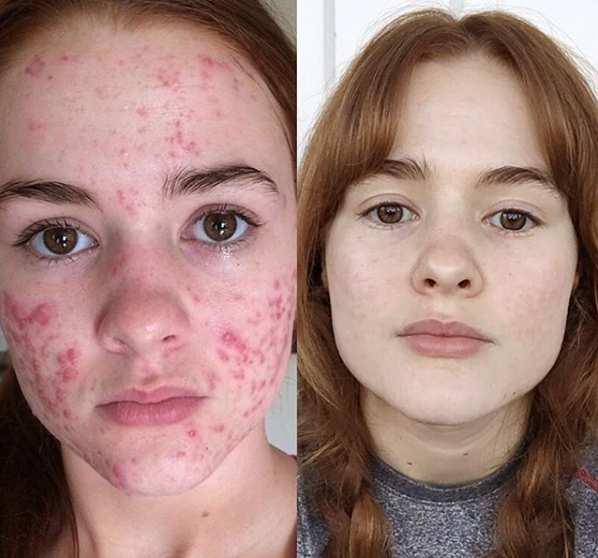 severe cystic acne accutane