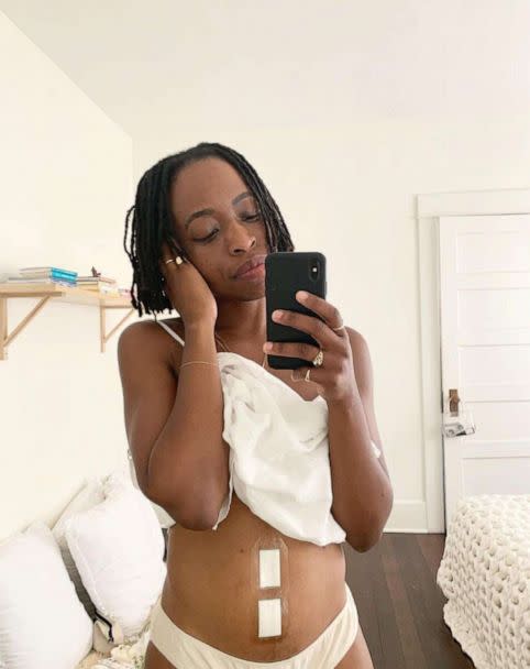 PHOTO: Erica Chidi is pictured while recovering from a 2019 procedure to remove uterine fibroids. (Erica Chidi)